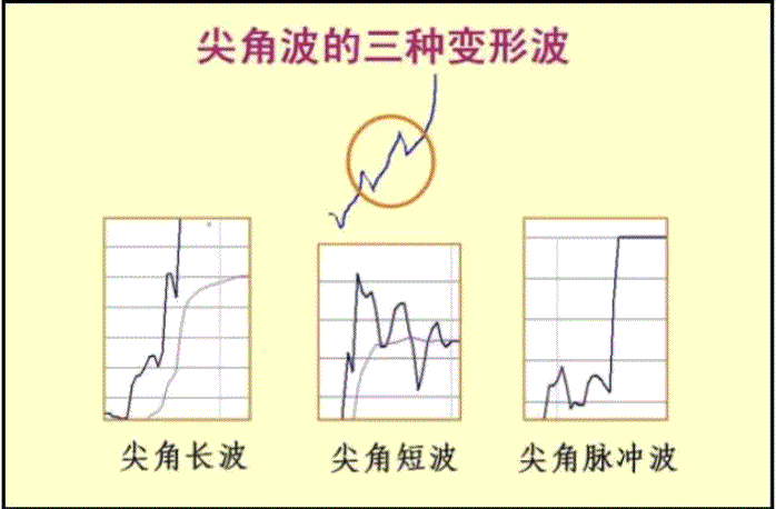 股票盤口分時語言之三大分時走勢類型 2:尖角波(圖解) 股票盤口分時語言之三大分時走勢類型 2:尖角波(圖解),拾荒網